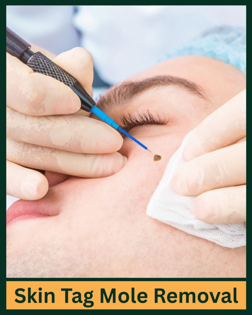 Skin tag Mole Removal treatment in punjabi bagh