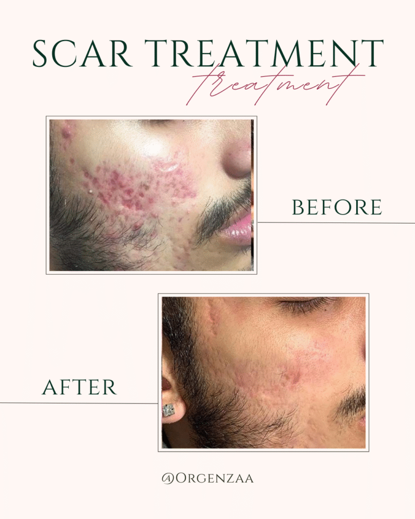 Acne Scar Treatment In Sonopat
