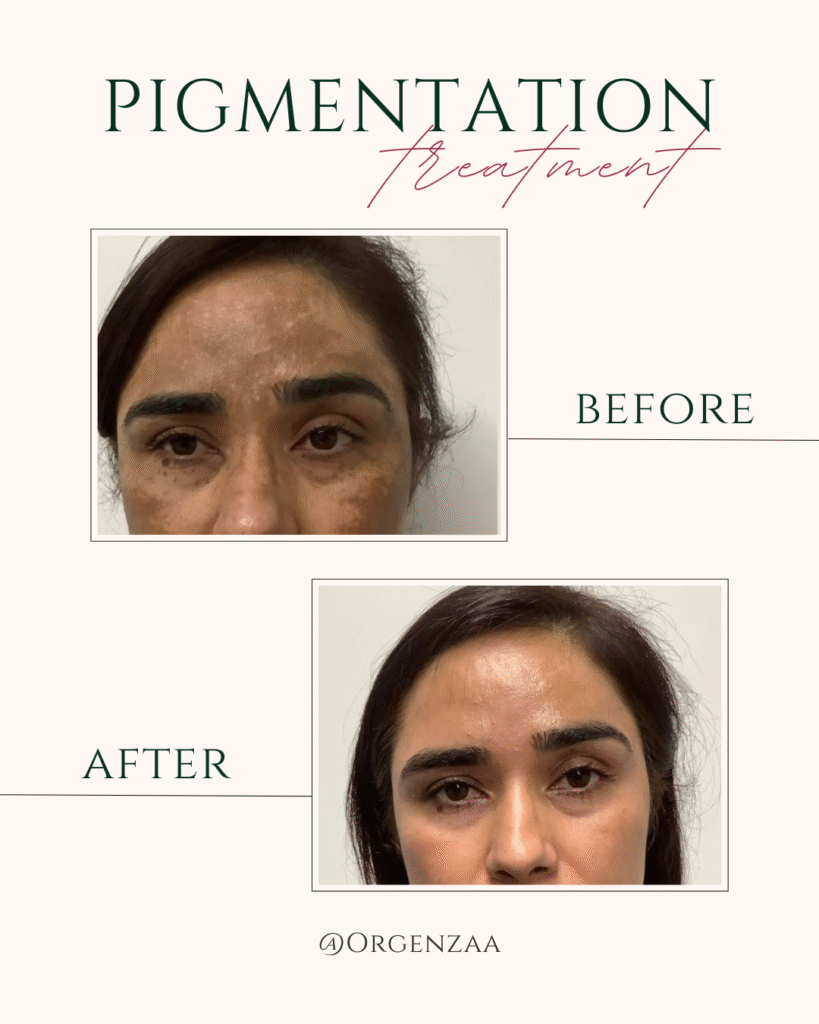 Pigmentation Treatment Sonipat