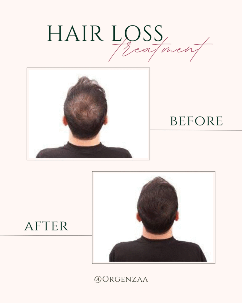Hair Loss Treatment In Sonipat