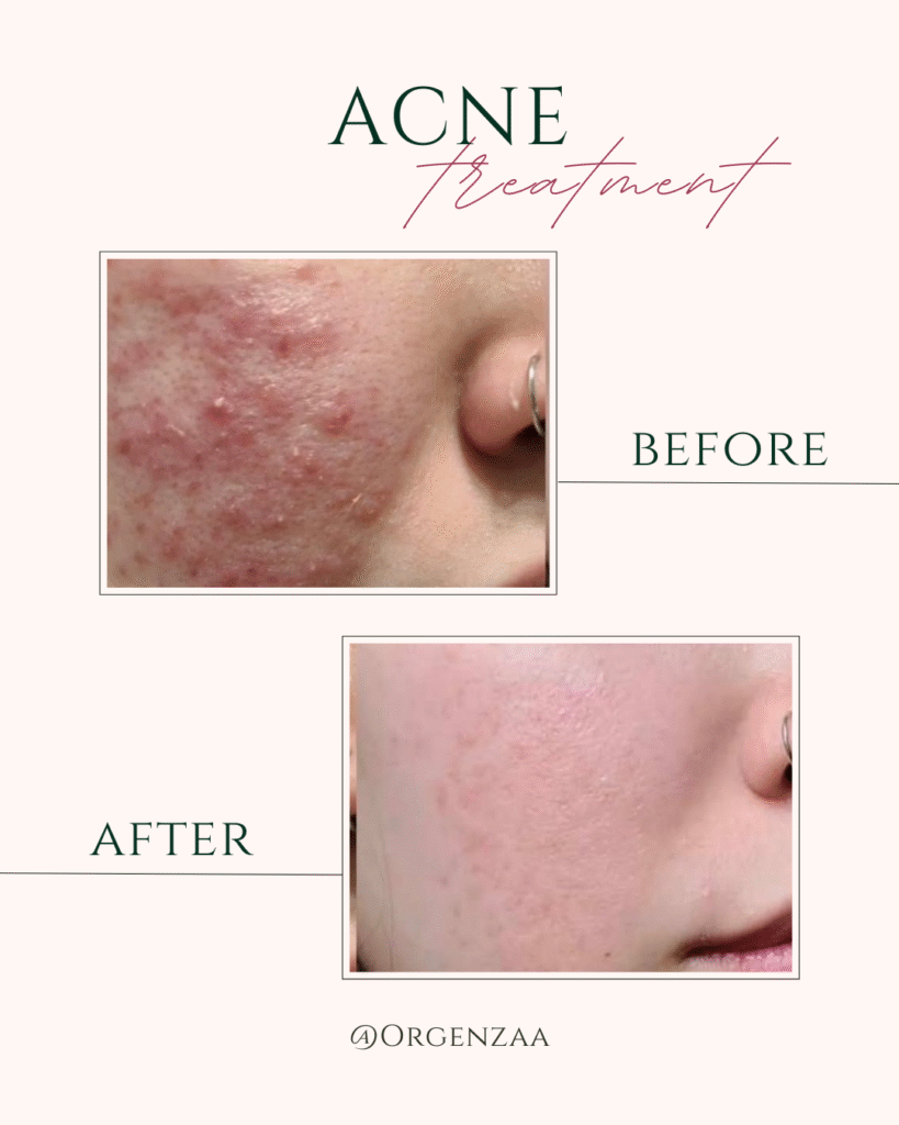 Pimple Treatment In Sonipat